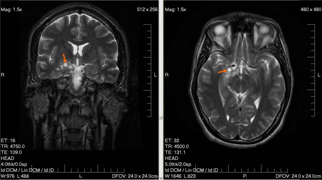 tumor